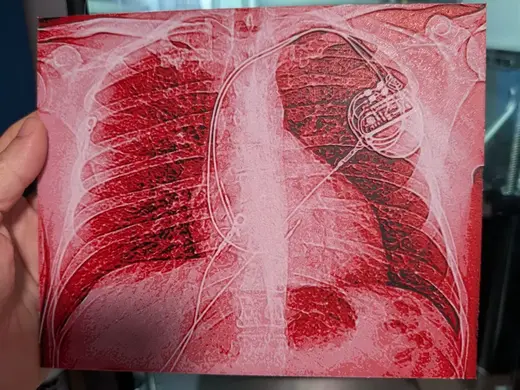 Pacemaker Cardiologist Valentine Chroma X-Ray