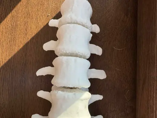 Lumbar Spine - Real Patient 3D Model