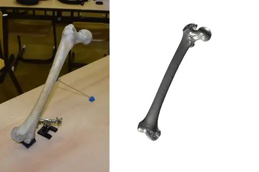 Thigh Bone Scan - Femur (R)